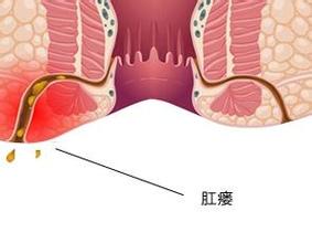 什么是肛瘘呢？