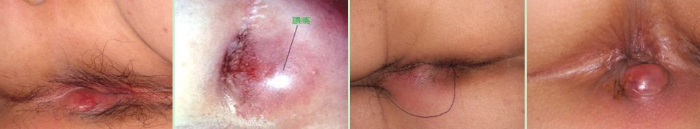 屁眼有肿块——肛周脓肿机率大