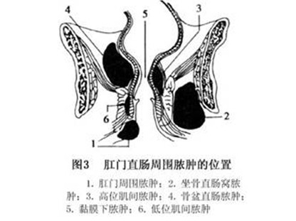 肛周脓肿发生位置