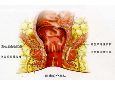 肛瘘有哪些种？
