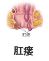 肛瘘