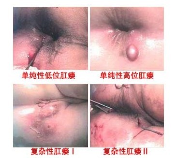 肛瘘症状图
