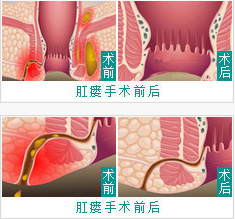 肛瘘治疗前后图