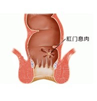 肛门息肉