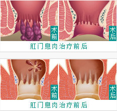 肛门息肉前后对比图
