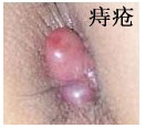 痔疮