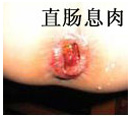 直肠息肉