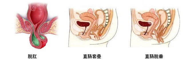 直肠脱垂症状