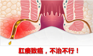 痔瘘危害