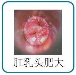 肛乳头肥大