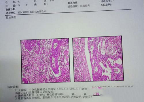 病理诊断报告后