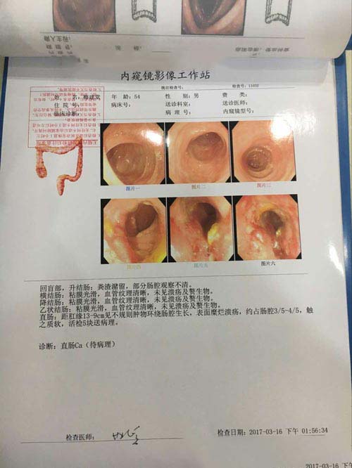 电子肛肠镜检查结果